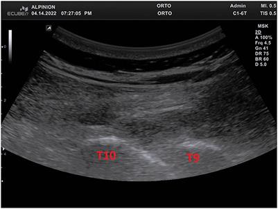 The effect of ultrasound-guided erector spinae plane block combined with dexmedetomidine for postoperative pain management in lumbar spine surgery: A case-based discussion